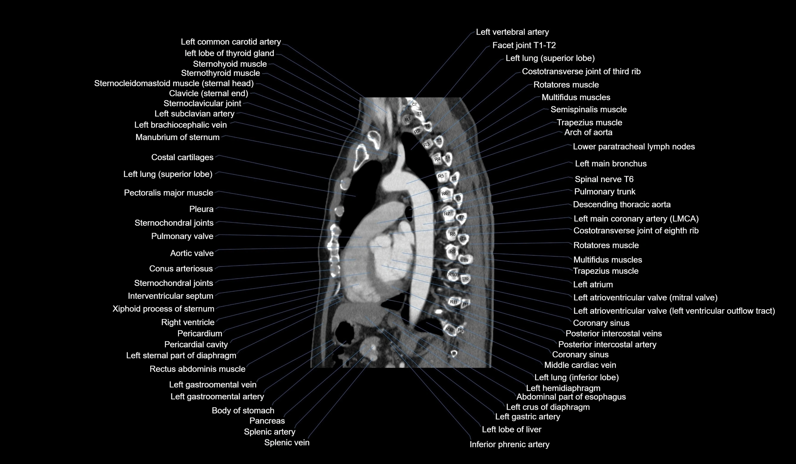CT chest (thorax) labelled sagittal cross sectional anatomy radiology image-00081.webp